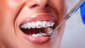 Aparelho dentário convencional (fixo) — OrthoCorrect