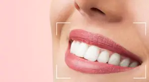 Facetas de porcelana — OrthoCorrect