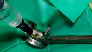 Tratamento de canal (endodontia) — OrthoCorrect
